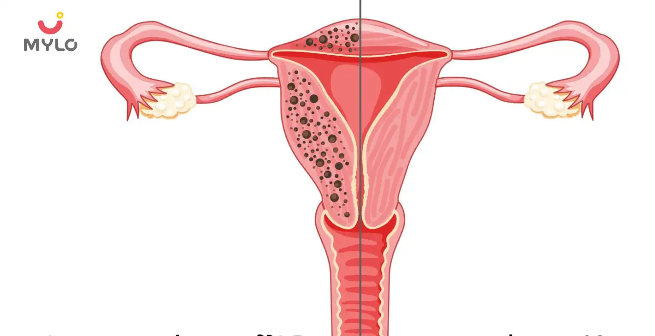 Adenomyosis Vs Endometriosis: How to Spot the Symptoms and Seek Early Intervention  