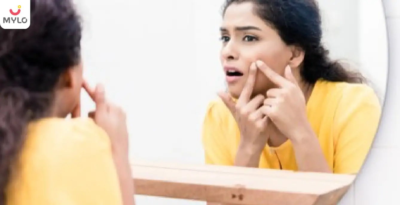 How to Get Rid of Acne in Hindi | मुँहासों से राहत दिलाएँगे ये टॉप 5 तरीक़े