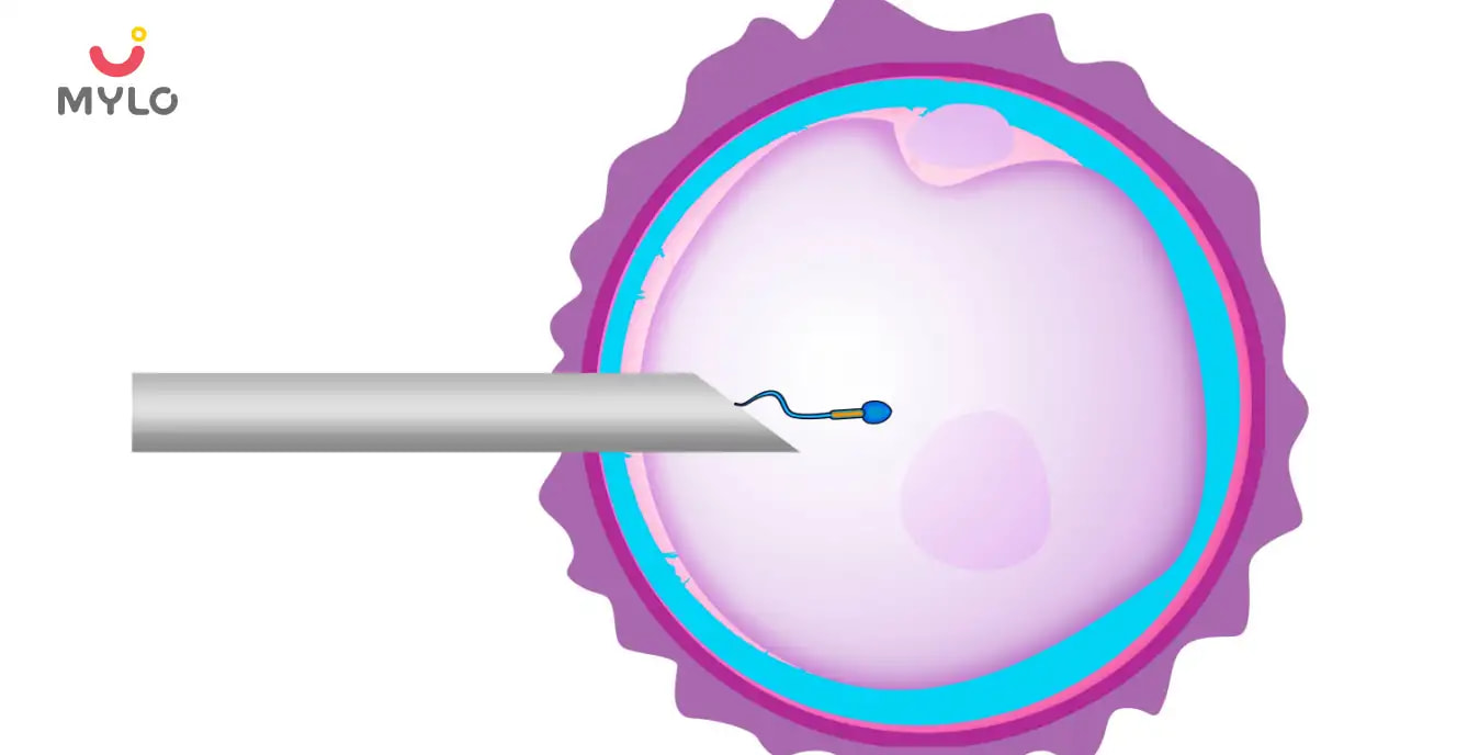 Intracytoplasmic Sperm Injection (ICSI) How It Can Help Treat Male Infertility
