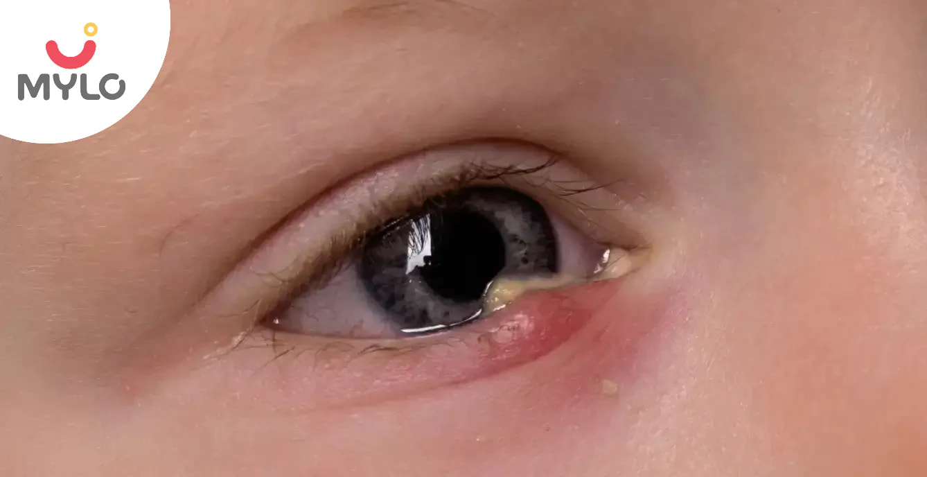 Conjunctivitis in Toddlers & New Borns