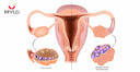 Images related to Ovarian Stimulation: Understanding the Process and What to Expect