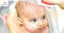 Images related to Cradle Cap: Causes, Symptoms & Treatment in Infants