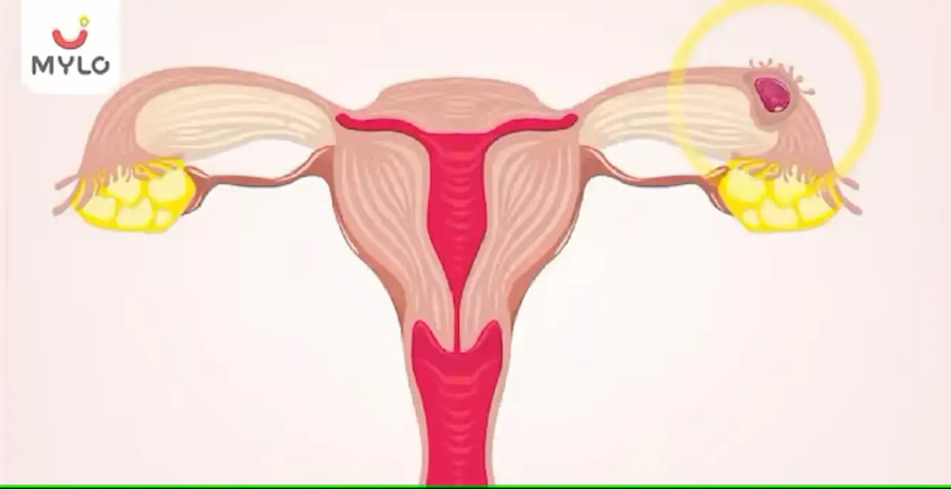 இடம் மாறிய கர்ப்பத்தை (எக்டோபிக் பிரக்னன்ஸி)முன்கூட்டியே கண்டறிவது எப்படி?