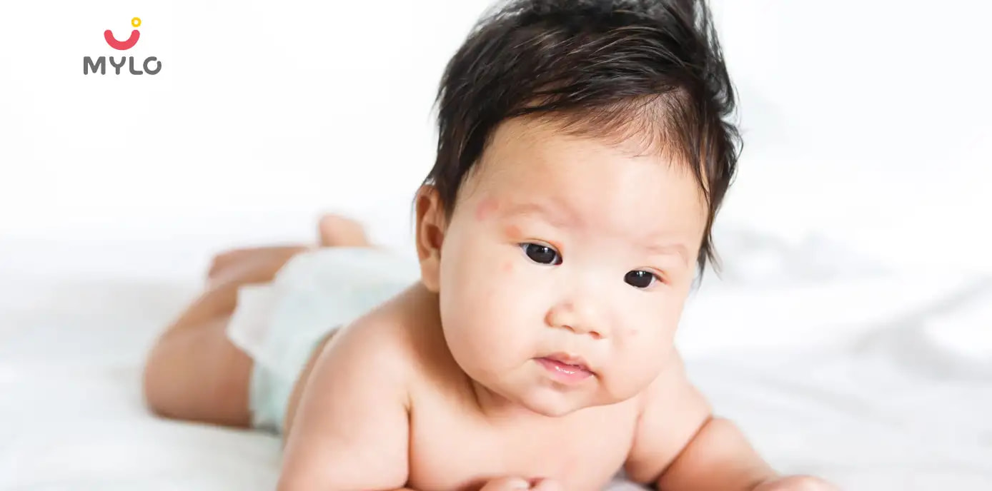 Baby Acne in Hindi | बच्चों को भी होते हैं मुँहासे! जानें क्या होते हैं कारण