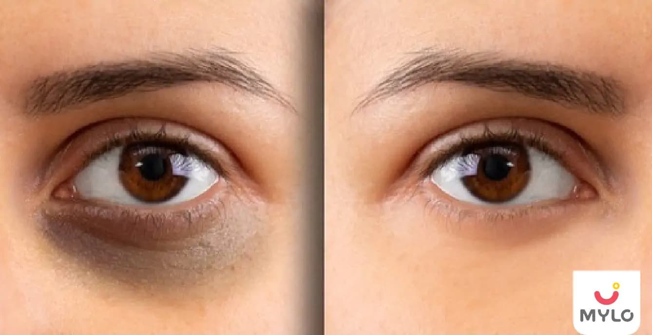 डार्क सर्कल्स से छुटकारा दिलाने में मदद करती है इस तरह की अंडर आई क्रीम | Under eye cream to get rid of dark circles in Hindi