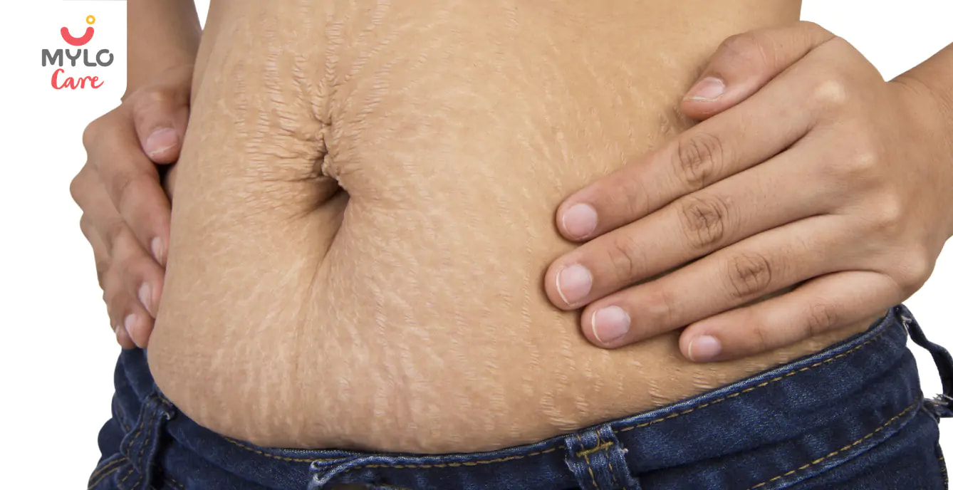 Stretch Marks On Stomach: Causes and Treatments