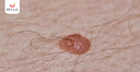 Images related to Giant Congenital Melanocytic Nevus: Causes, Symptoms, & Treatment 