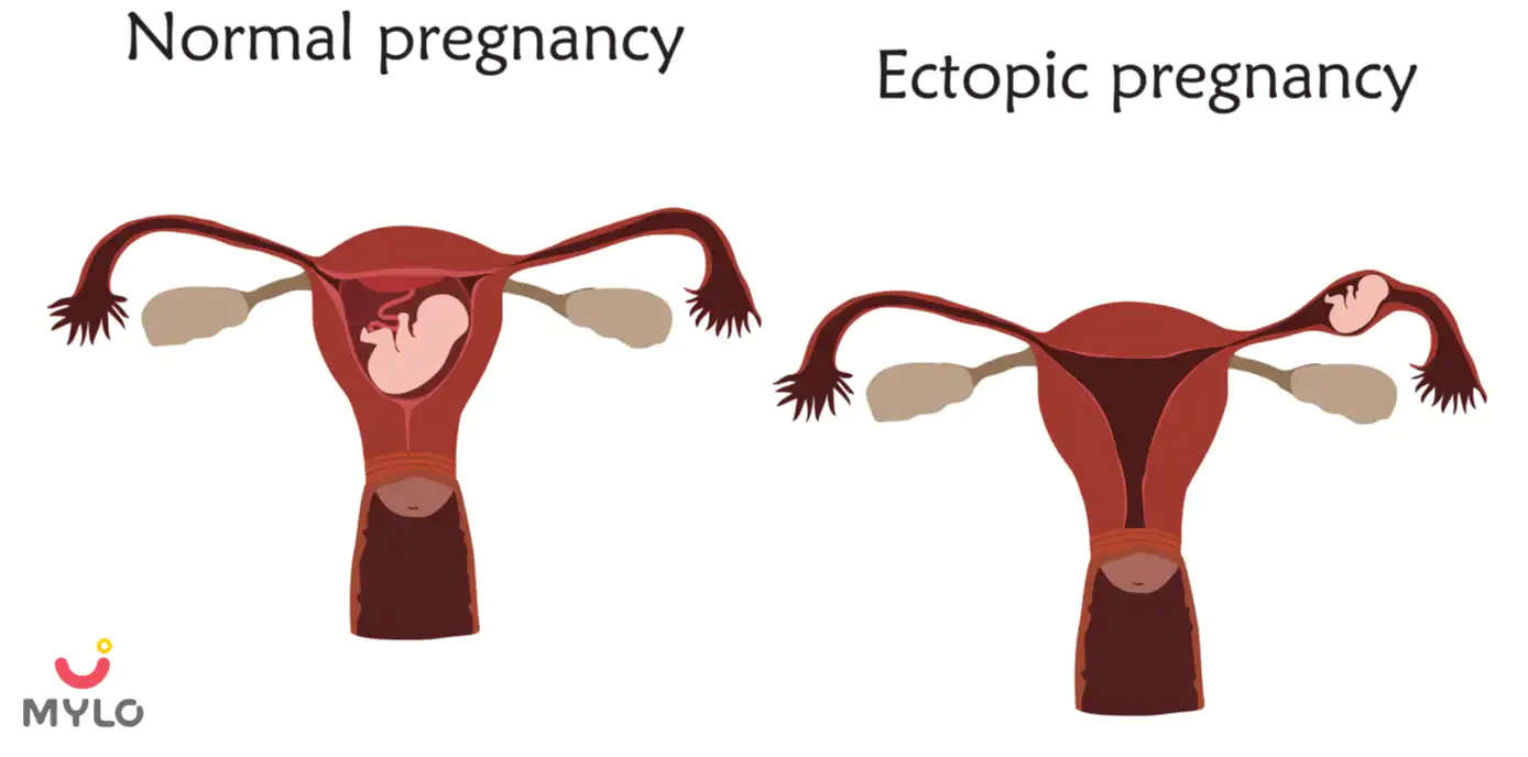 What is Ectopic Pregnancy - Symptoms, Causes, Treatment, Prevention & How to Detect it?