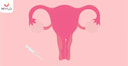 Images related to Is IUI (Intra Uterine Insemination) Painful?