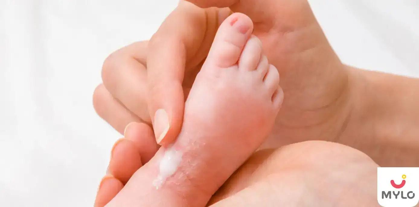 குழந்தைகளுக்கு உள்ள வறண்ட சருமம்: நீங்கள் தெரிந்து கொள்ள வேண்டியவை ( Dry Skin in Babies: All that you need to know In Tamil)