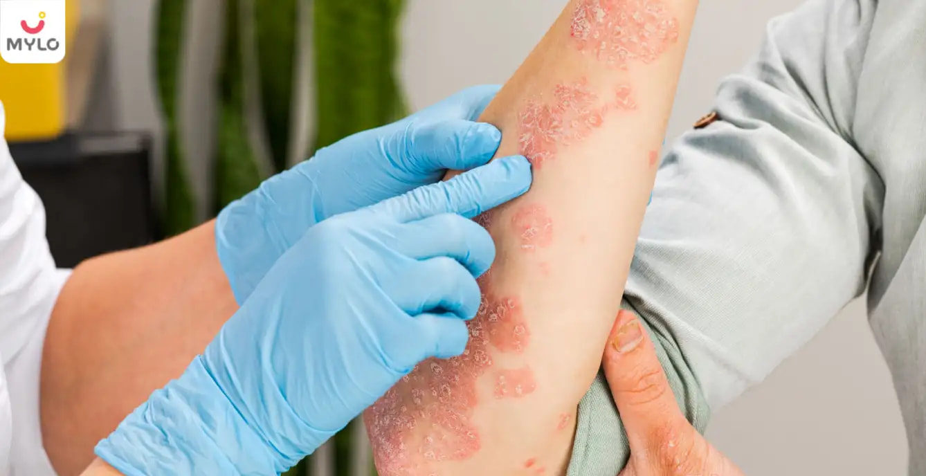 Causes of Eczema in Hindi| इन कारणों से होता है एक्जिमा!