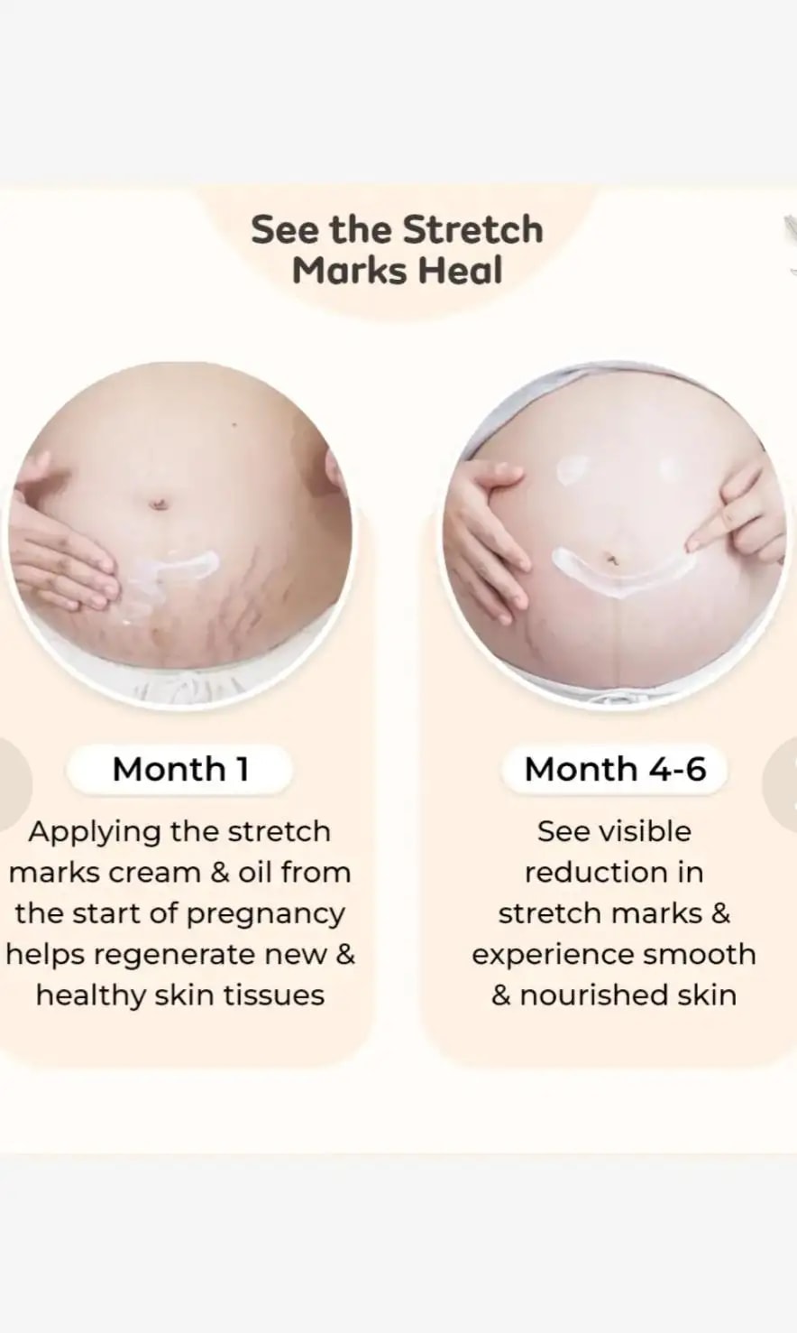 Stretch Marks Kit - Removes Scars | Made with Natural Ingredients | Tightens Skin - (1 Stretch Mark Oil - 100 ml, 2 Stretch Marks Cream - 100ml each)