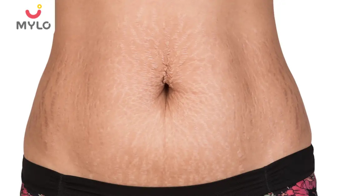 Stretch Marks Removal: Tips & Remedies