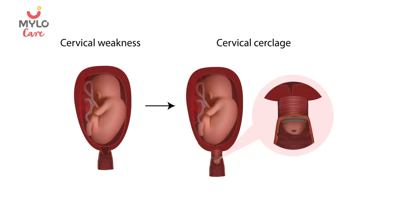 Cervical Cerclage: A Closer Look at the Procedure and Its Benefits 