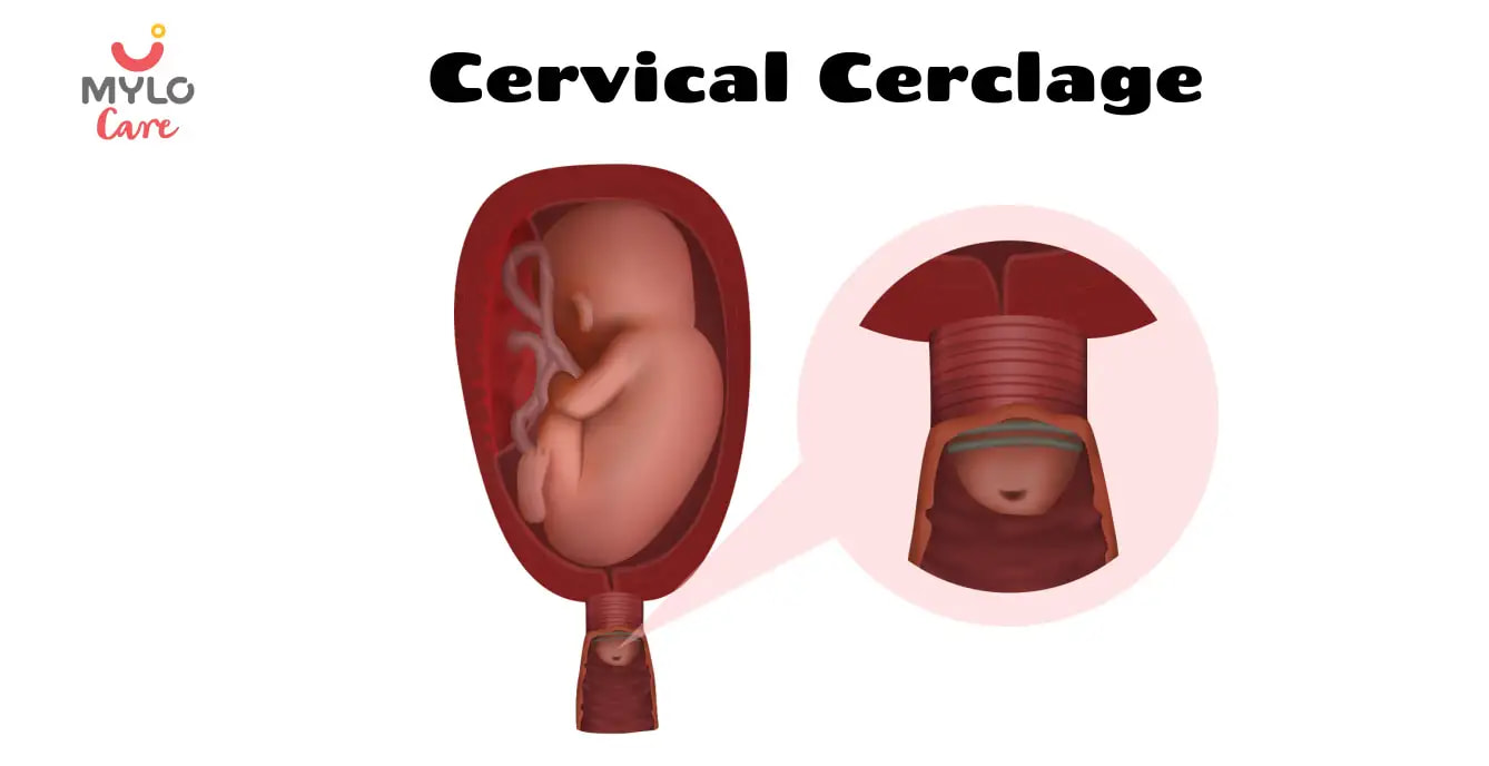 Things Not to Do After Cervical Cerclage for a Healthy Pregnancy