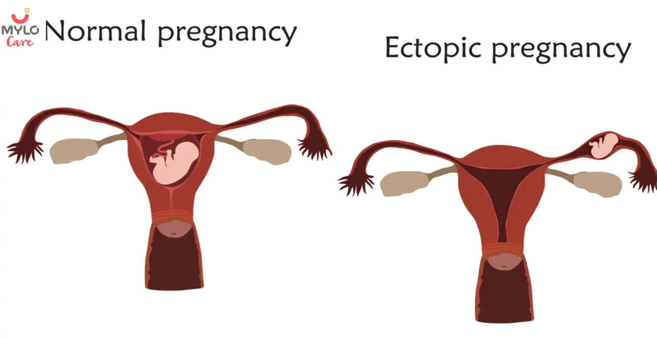எக்டோபிக்/ இடம் மாறிய கர்ப்பம் என்றால் என்ன - அறிகுறிகள், காரணங்கள், சிகிச்சை, தடுப்பு & அதை எவ்வாறு கண்டறிவது? What is Ectopic Pregnancy - Symptoms, Causes, Treatment, Prevention & How to Detect it in Tamil?