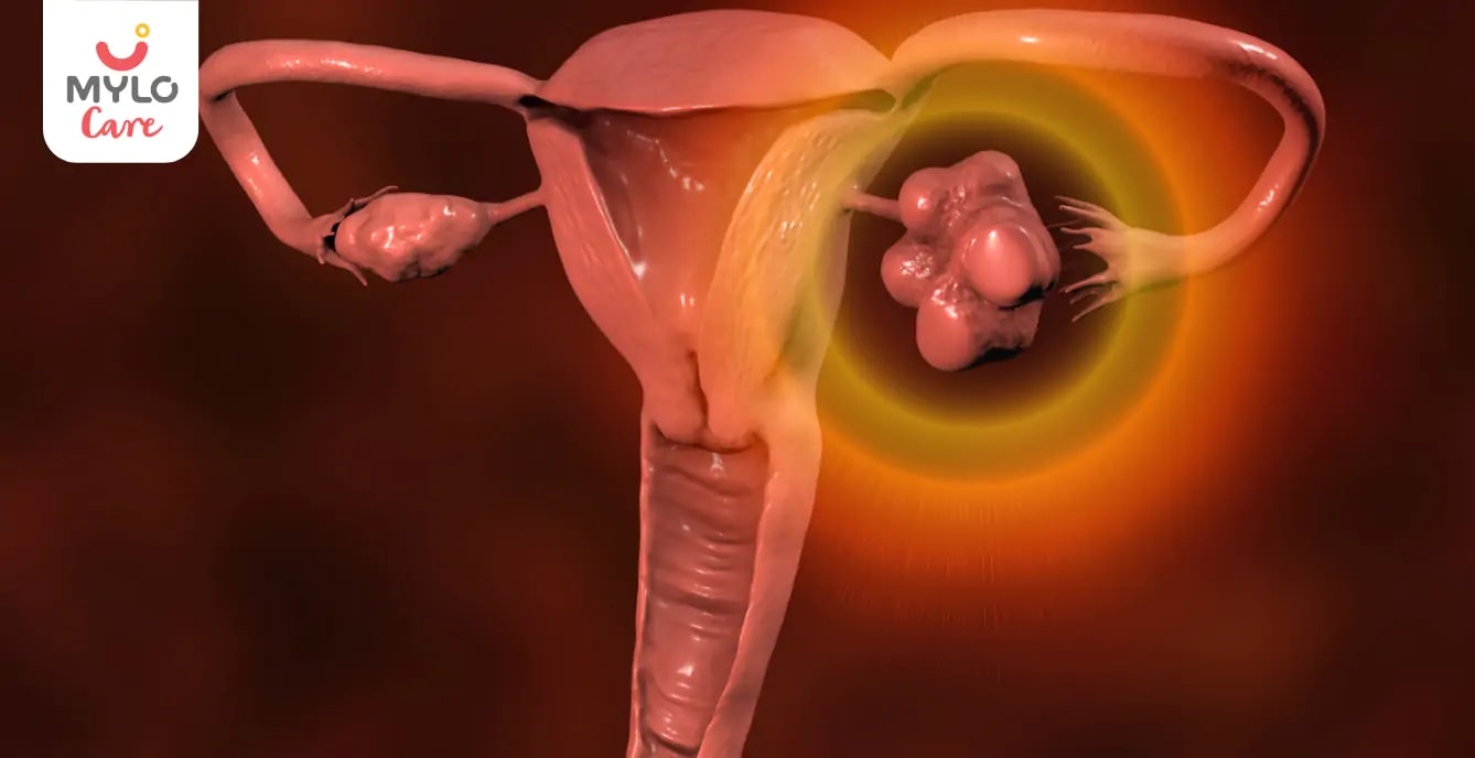 Polycystic Ovarian Disease (PCOD): Navigating Causes, Effects, and Coping Strategies