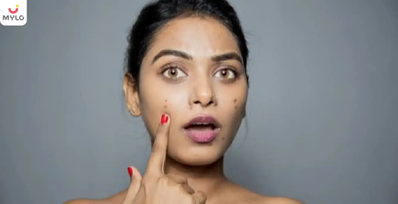 Acne Meaning in Hindi | एक्ने क्या होते हैं और आप इससे कैसे राहत पा सकते हैं?