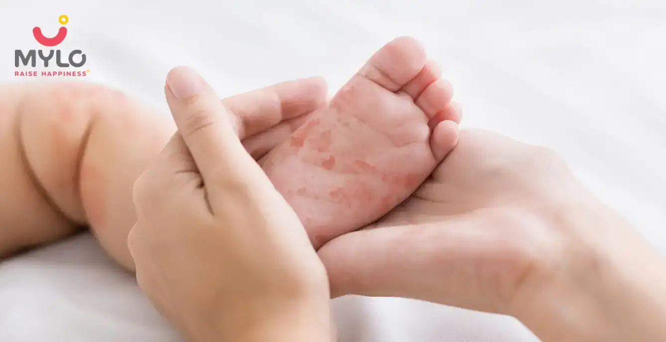 What to do if my child has measles?