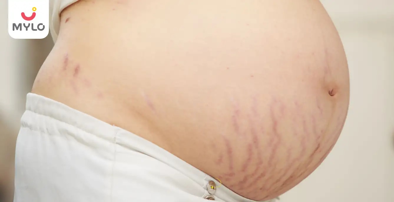 ஸ்ட்ரெட்ச் மார்க்ஸ் தோன்றக் காரணம் மற்றும் அவற்றை எவ்வாறு போக்குவது?