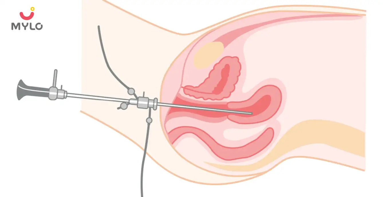 Hysteroscopy: Everything You Need to Know About This Minimally Invasive Procedure