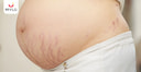 Images related to Purple Stretch Marks During Pregnancy in Hindi | प्रेग्नेंसी में पर्पल स्ट्रेच मार्क्स किस बात की ओर करते हैं इशारा?