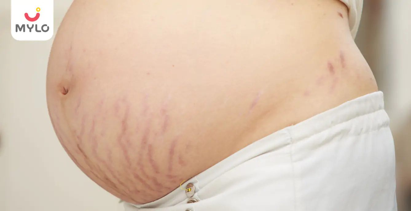 Purple Stretch Marks During Pregnancy in Hindi | प्रेग्नेंसी में पर्पल स्ट्रेच मार्क्स किस बात की ओर करते हैं इशारा?