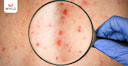 Images related to Rubella IgG in Pregnancy