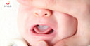 Images related to Baby's Mouth Thrush: Symptoms, Causes & Treatment